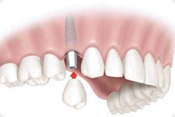Sustitución de un único diente. Clinica dental Armonía