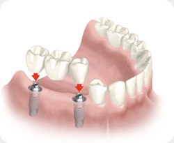 Sustitución de varias piezas dentales. Clinica dental Armonía