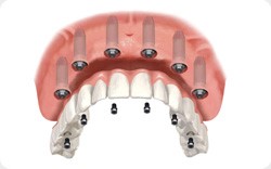 Prótesis fija sobre implantes.Prótesis removibles implantosoportadas. Clinica dental Armonía