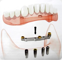 Prótesis removibles implantosoportadas. Clinica dental Armonía
